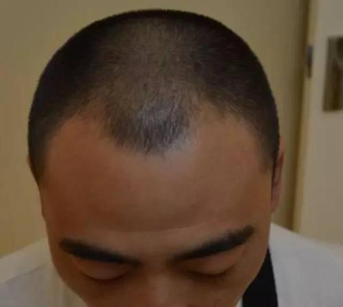 梦见掉头发秃一块