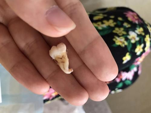 梦见玻璃扎肉里拔出来