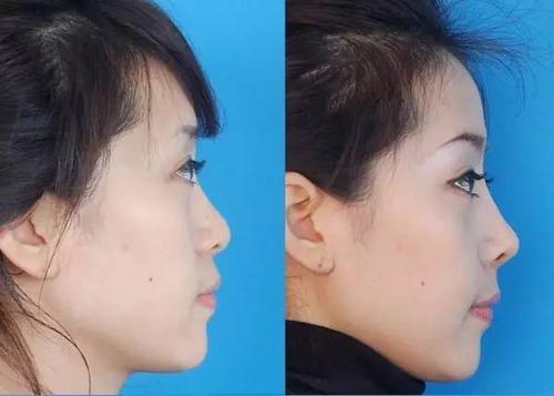 梦见自己隆鼻 梦见自己隆鼻