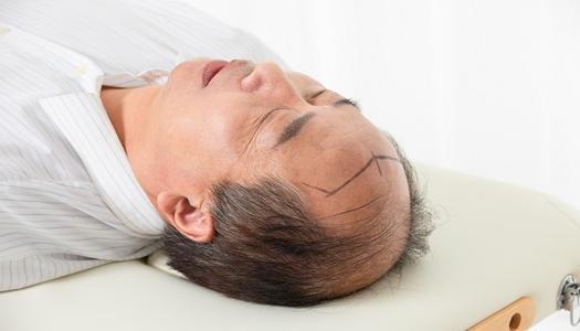 梦见老公变成秃顶