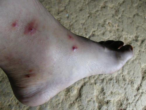 梦见身上长满包