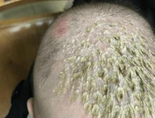 梦见头上有包 梦见头上有包