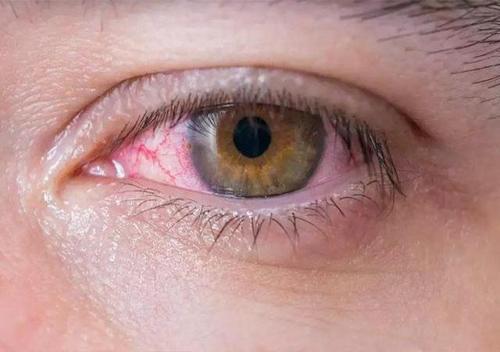 梦见眼睛发红