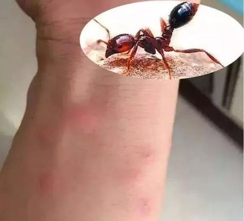 梦见被蚂蚁咬