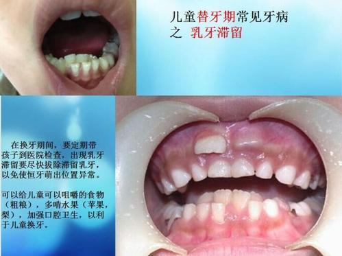 梦见掉了好多牙