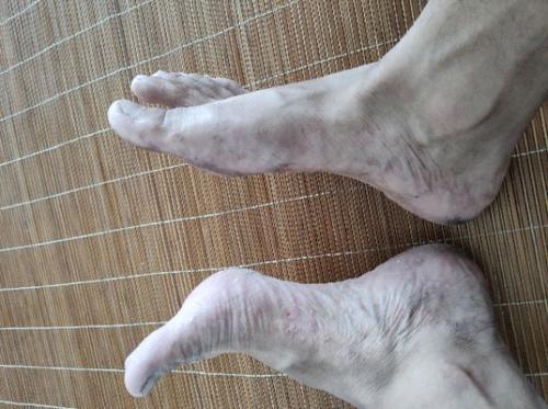 梦见右脚出血