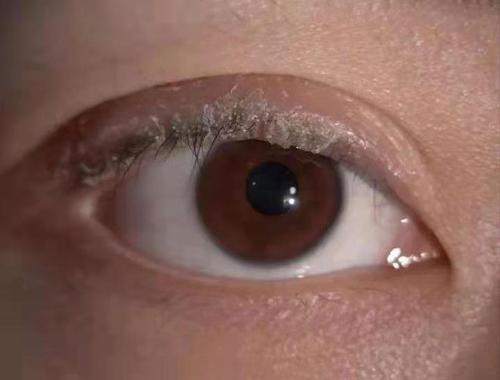梦见眼睛长虫