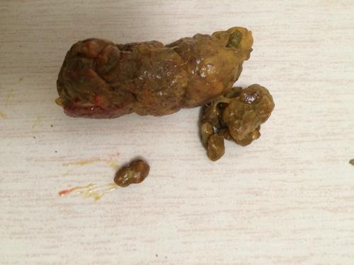 梦见自己拉了好多屎
