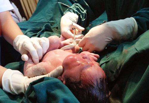 孕妇梦见自己剖腹产