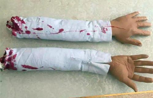 梦见别人断腿
