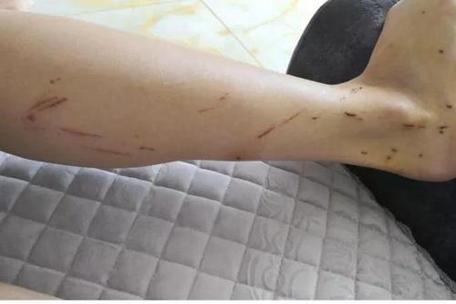 梦见身上有伤口 梦见身上有伤口