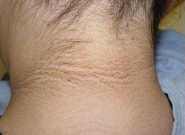 梦见脖子黑 梦见脖子黑