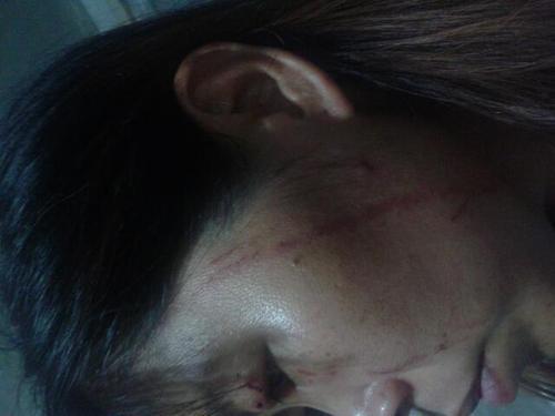 梦见脸被人抓伤