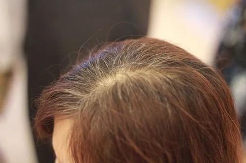 梦见拔白发流白脓 梦见拔白发流白脓