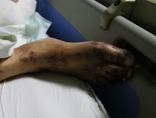 梦见大腿腐烂了 梦见大腿腐烂了