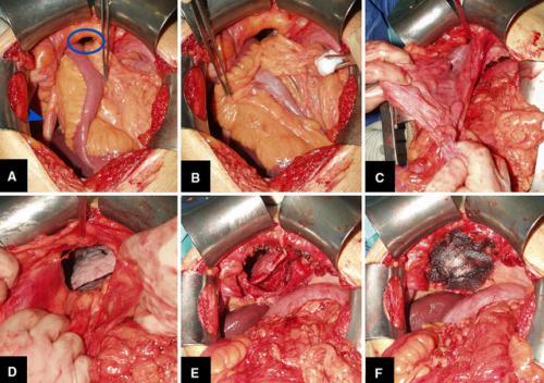 梦见肚子开刀 梦见肚子开刀