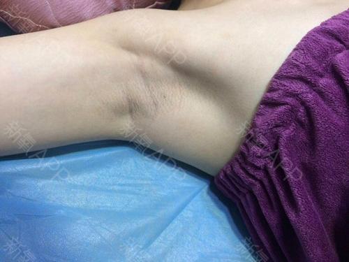 梦见腋毛