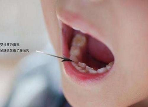 梦见牙快掉了