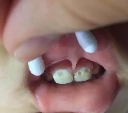 梦见牙齿又烂又黑