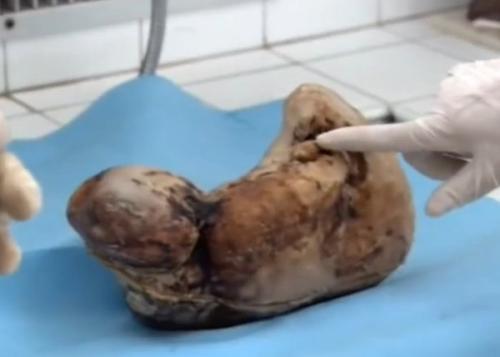 梦见胎死腹中