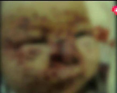 梦见被老鼠咬脸