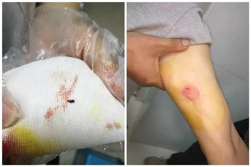 梦见腿上的虫子往肉里钻