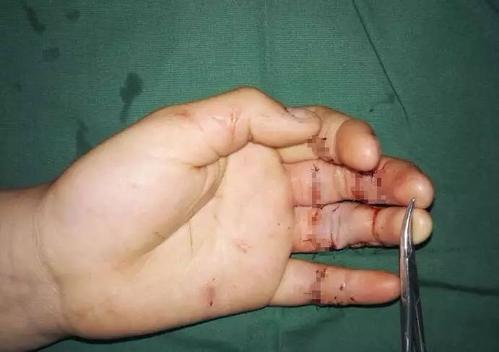 梦见舌头被针扎