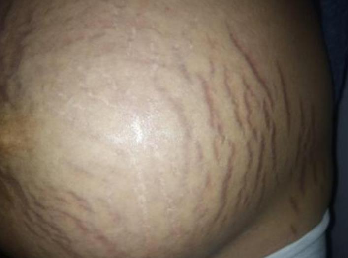 梦见肚子进水裂开 梦见肚子进水裂开