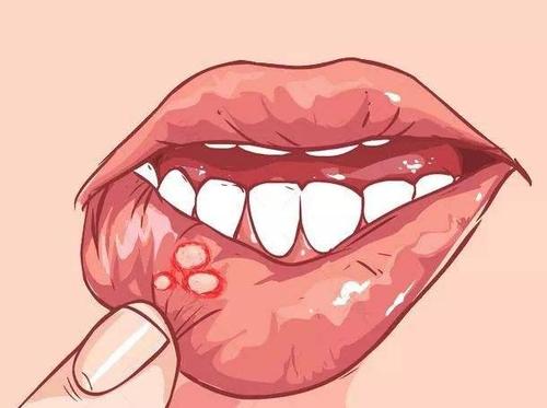 梦见溃疡