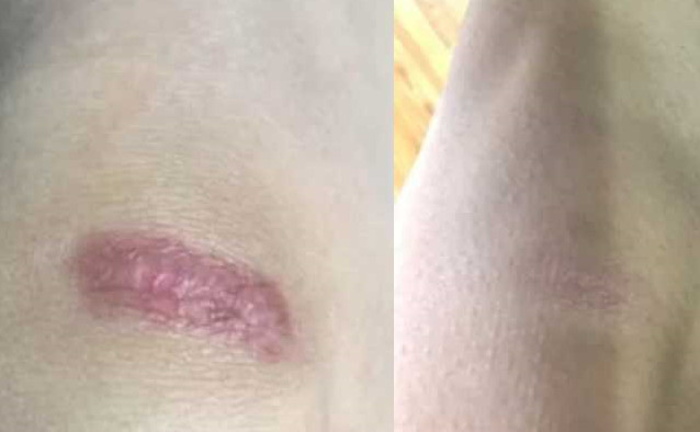 梦见去医院祛疤 梦见去医院祛疤